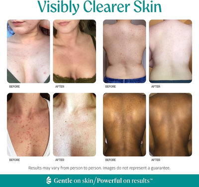 Level 2 Mandelic Acid Serum | Body Acne Treatment