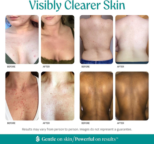 Level 2 Mandelic Acid Serum | Body Acne Treatment