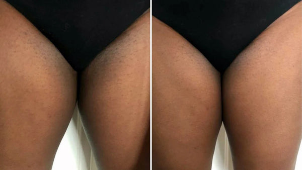 Inner Thighs