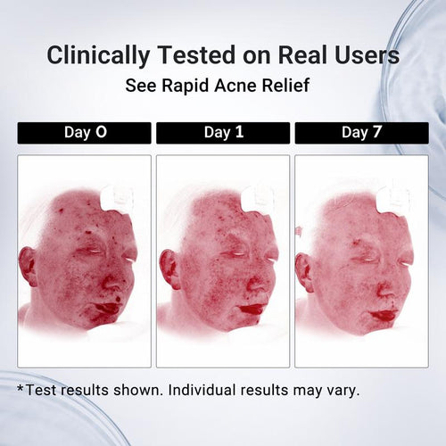 Pimple Drying Lotion