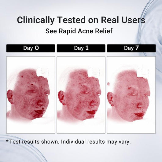 Pimple Drying Lotion